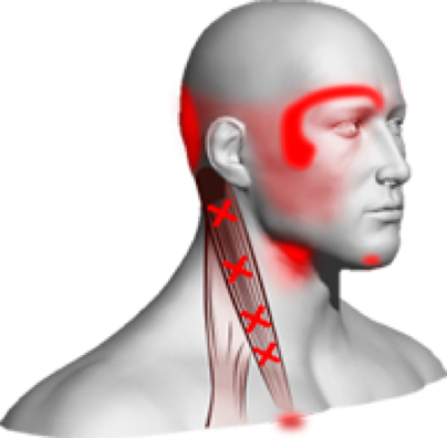 Fizio GP - Problemi kralježnice - bolovi u vratu