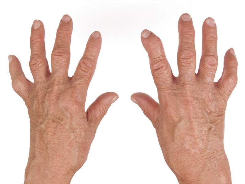 Fizio GP - reumatoidni artritis