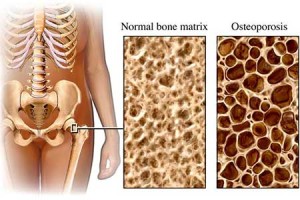 Fizio GP - osteoporoza